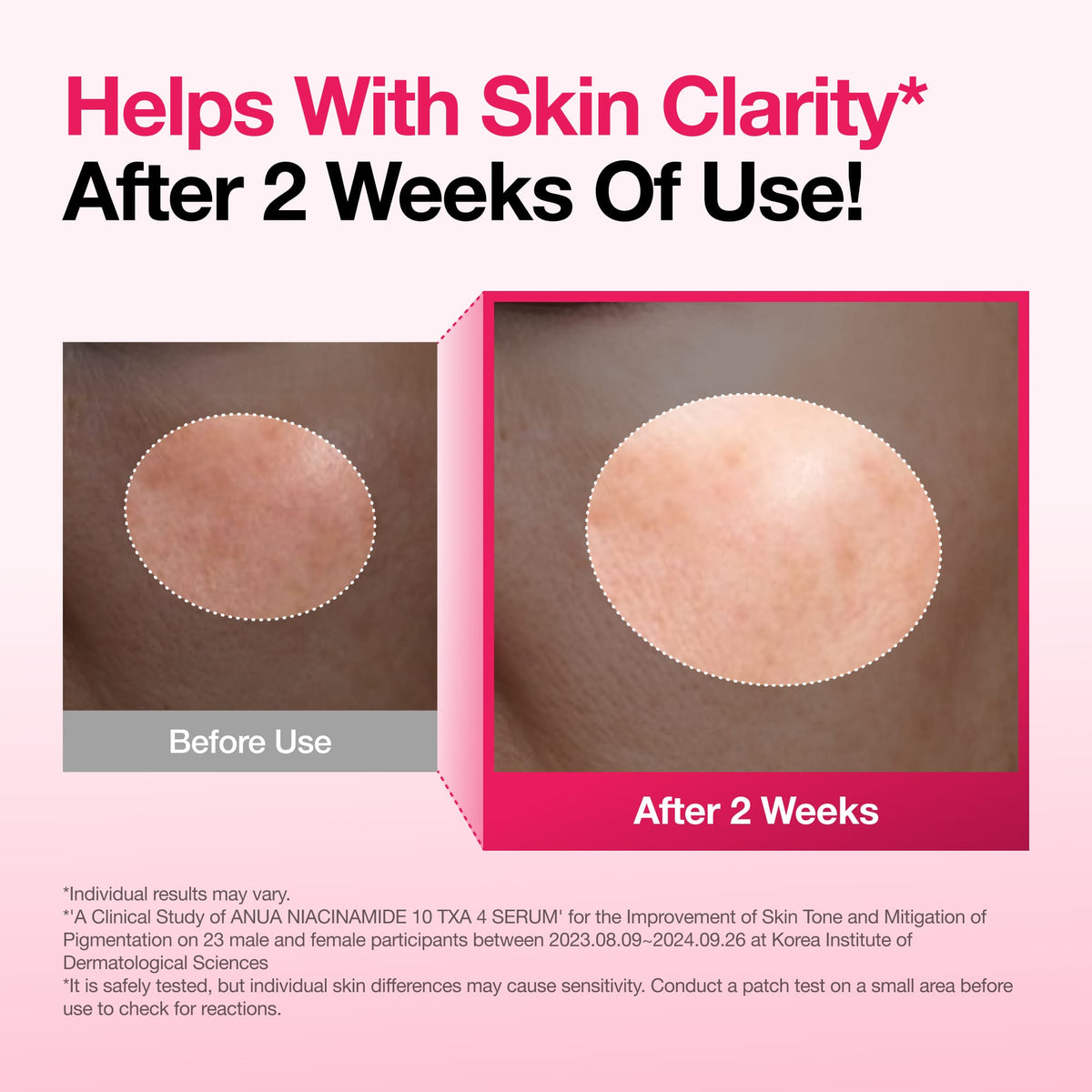 Anua Niacinamide 10 TXA 4 Serum skin clarity study with individual results disclaimer