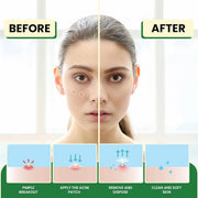 Elemental Wellness Hydrocolloid Acne Patches, 36 Count