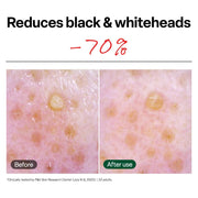 Dr.G Brightening Vita Peeling Pads 70 Pads - blackhead whitehead results
