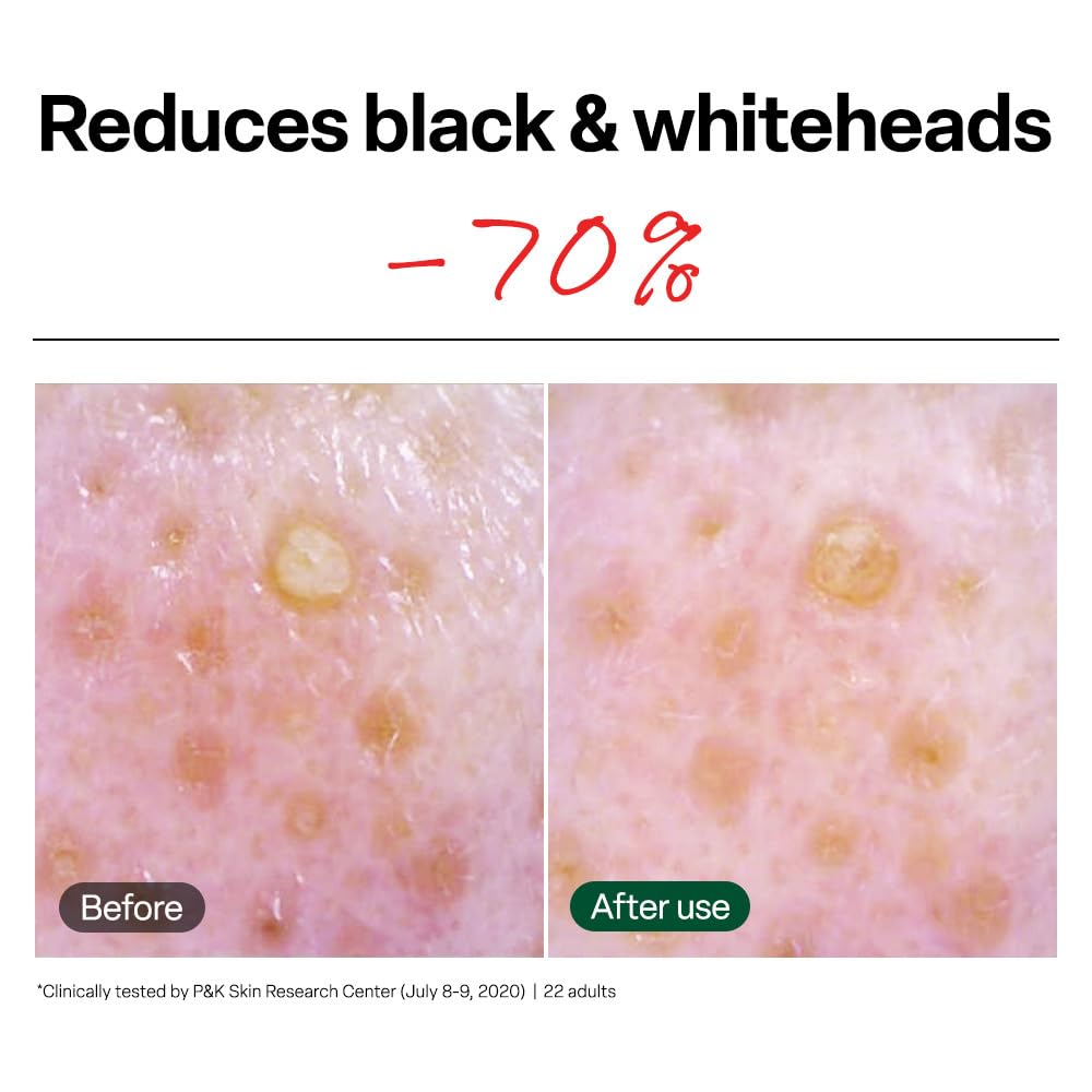 Dr.G Brightening Vita Peeling Pads 70 Pads - blackhead whitehead results