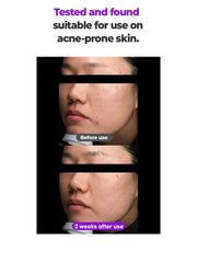 FATION Nosca9 Pore Enhancing Serum: acne prone test
